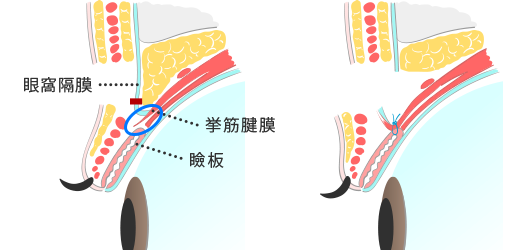 保険適用の眼瞼下垂術（挙筋腱膜前転術)