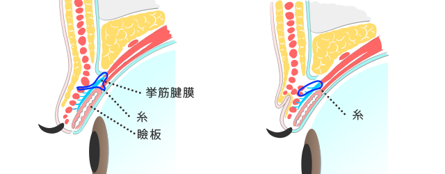 切らない眼瞼下垂（スーパー埋没法）とは