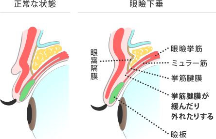 老化が原因の眼瞼下垂