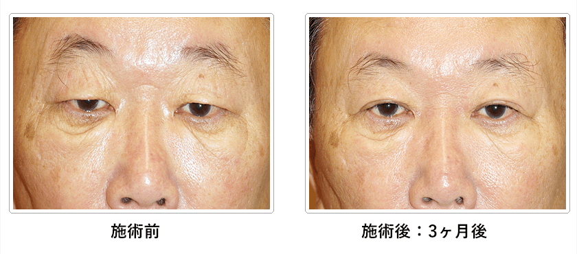 保険適用の眼瞼下垂手術(挙筋前転法)の症例