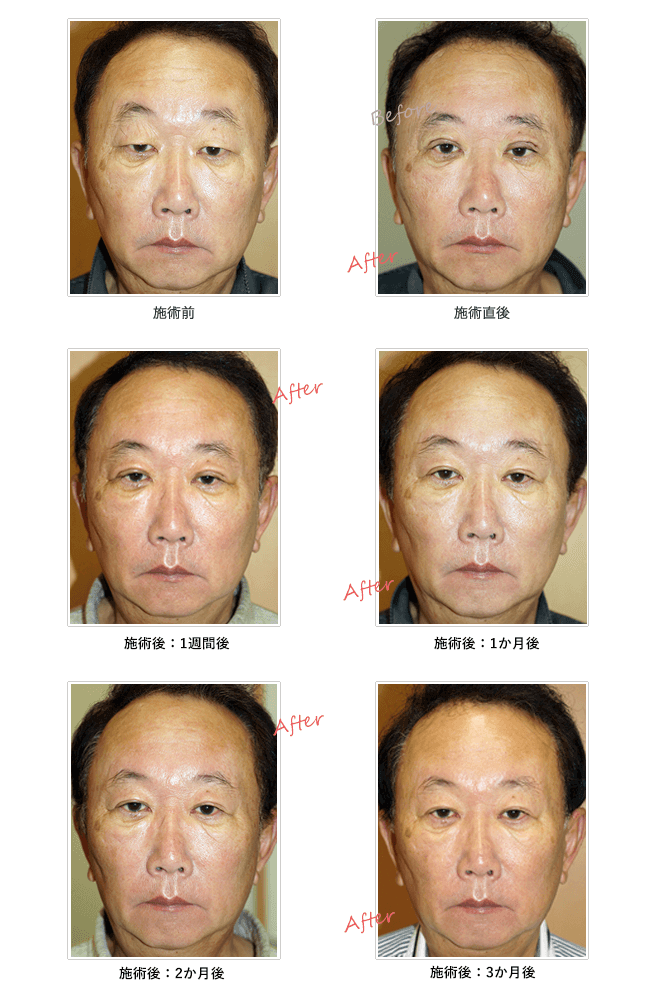 保険適用の眼瞼下垂手術(挙筋前転法)