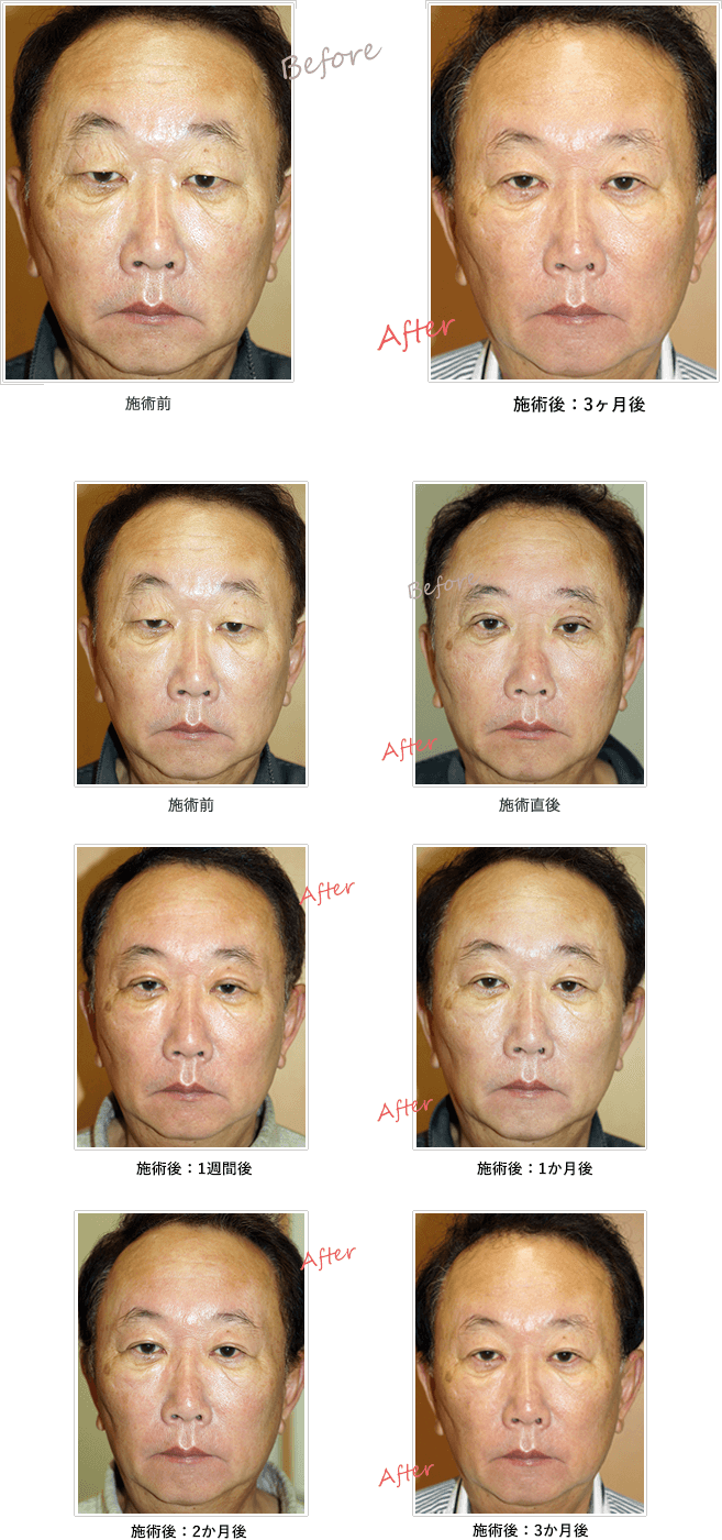 保険適用の眼瞼下垂手術