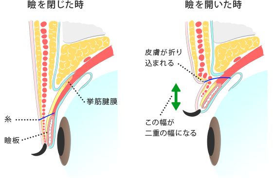 二重まぶた埋没法について