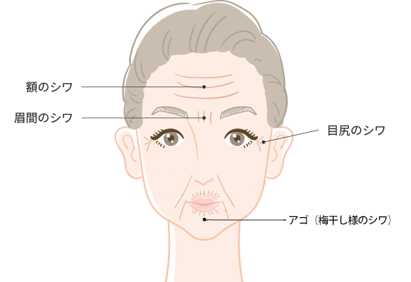 ヒアルロン酸注入・ボトックス注射の注入部位