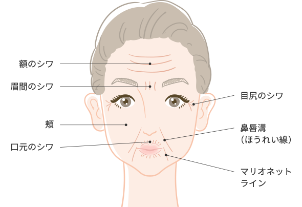 ヒアルロン酸注入の注入部位