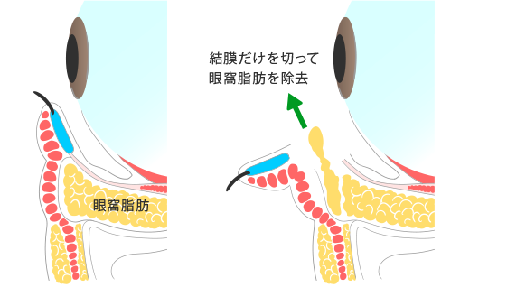 下まぶたの脂肪取りについて