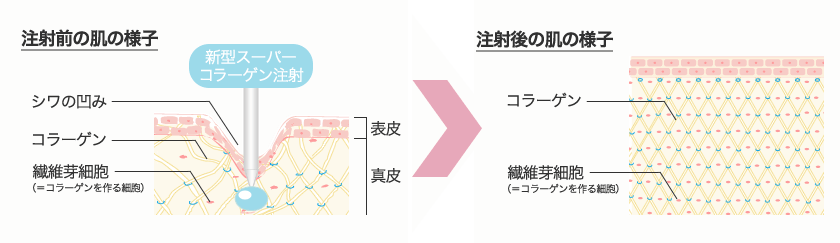 注射前、注射後の肌の様子