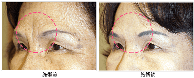 ほうれい線 眉間のシワ おでこのシワの治療にスーパーコラーゲン注射 眼瞼下垂症例4200件以上 保険診療から眼瞼下垂の修正術まで 大阪の立花クリニック