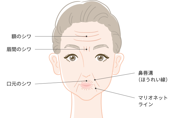 スーパーコラーゲン注射の注入部位