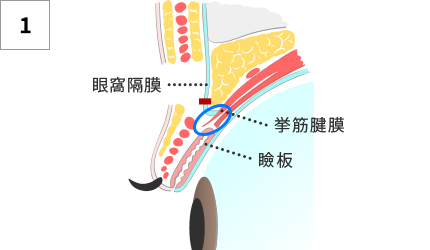 挙筋腱膜を切離