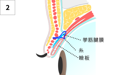 糸を挙筋腱膜に通す